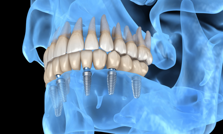 Santé bucco-dentaire : Des implants dentaires intelligents pour résister à la croissance bactérienne
