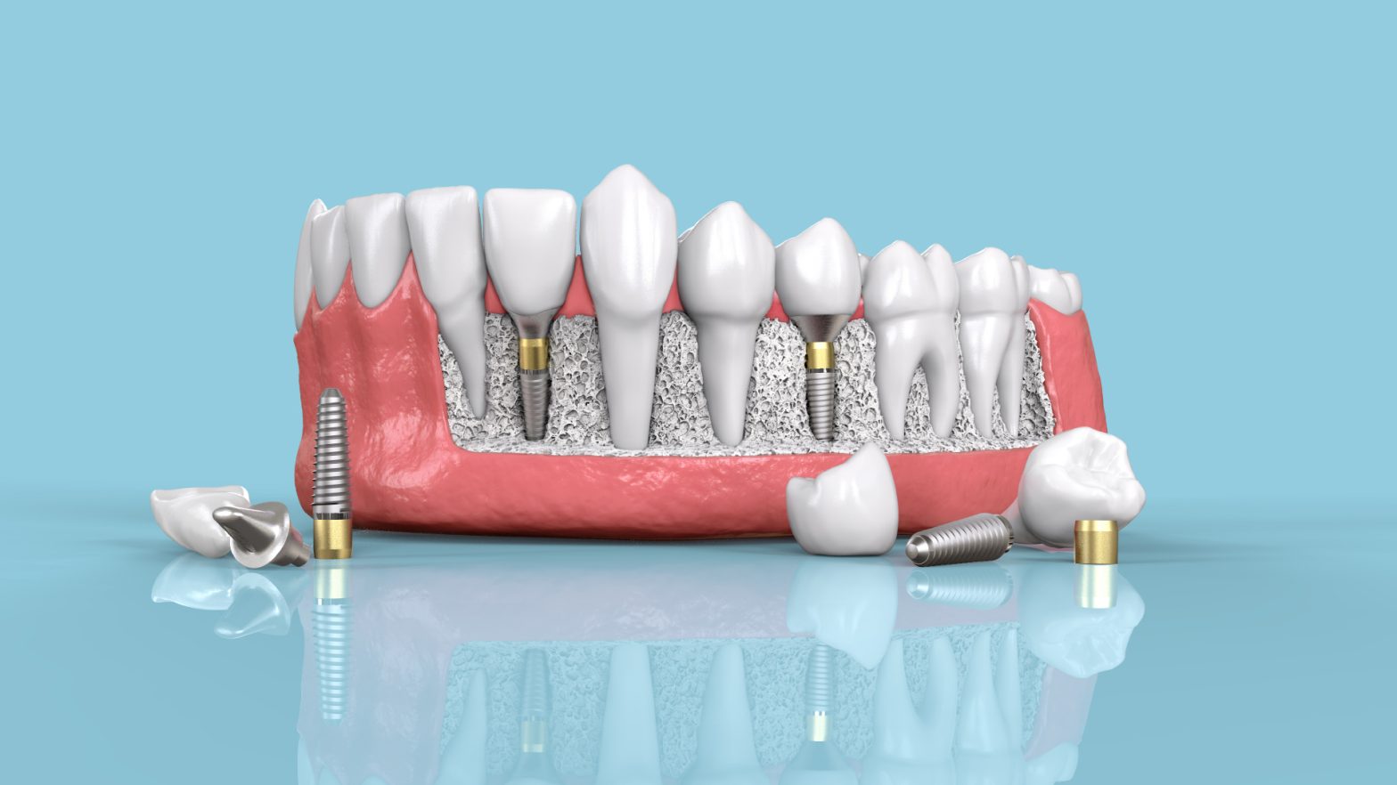 Comment bien choisir un implant dentaire