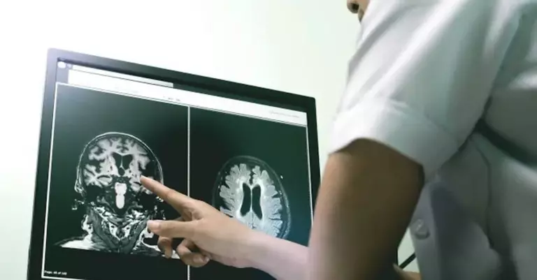 L&rsquo;Algérie lance le Registre national de l&rsquo;accident vasculaire cérébral (AVC)